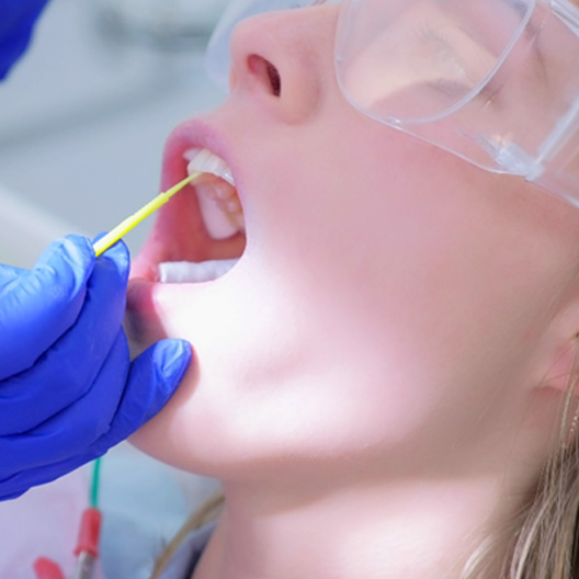Silver diamine fluoride is applied directly to the teeth to fight cavities