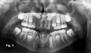Panoramic X-ray of child’s mouth with impacted teeth
