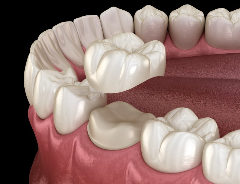 digital image of a dental crown